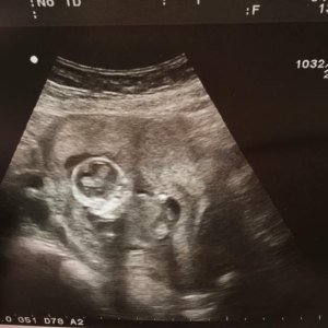 Ultrasound Photo
